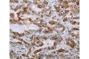 Immunohistochemistry of Human cervical cancer using NMT1 Polyclonal Antibody at dilution of 1:45 (NMT1 antibody)