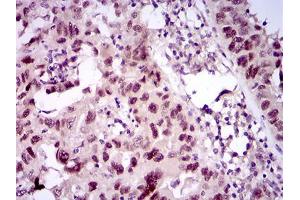 Immunohistochemical analysis of paraffin-embedded endometrial cancer tissues using TP53BP1 mouse mAb with DAB staining. (TP53BP1 antibody  (AA 574-773))