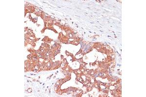 Immunohistochemistry of paraffin-embedded Human mammary cancer using PGD antibody (ABIN6127314, ABIN6145502, ABIN6145503 and ABIN6223639) at dilution of 1:100 (40x lens). (PGD antibody  (AA 184-483))