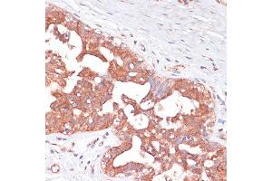 Immunohistochemistry of paraffin-embedded Human mammary cancer using PGD antibody (ABIN6127314, ABIN6145502, ABIN6145503 and ABIN6223639) at dilution of 1:100 (40x lens).