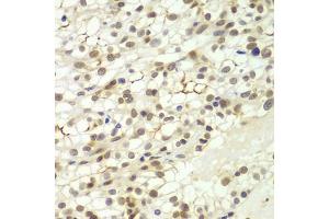 Immunohistochemistry of paraffin-embedded human kidney cancer using LHX4 antibody (ABIN5975324) at dilution of 1/100 (40x lens). (LHX4 antibody)