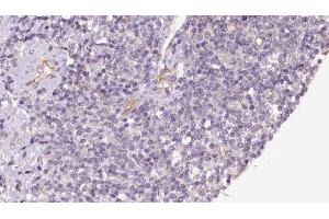 ABIN6273176 at 1/100 staining Human lymph cancer tissue by IHC-P. (TIMM44 antibody  (N-Term))
