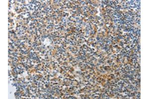 The image on the left is immunohistochemistry of paraffin-embedded Human tonsil tissue using ABIN7189642(AD7C-NTP Antibody) at dilution 1/25, on the right is treated with synthetic peptide.