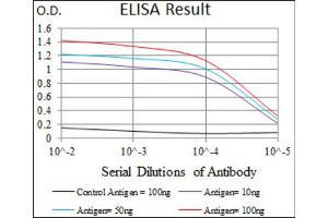 Immunohistochemical analysis of paraffin-embedded rectum cancer tissues using T antibody with DAB staining. (T Antigen (AA 257-309) antibody)