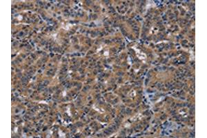 The image on the left is immunohistochemistry of paraffin-embedded Human thyroid cancer tissue using ABIN7191819(PDE4A Antibody) at dilution 1/40, on the right is treated with synthetic peptide. (PDE4A antibody)