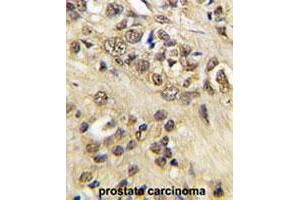 Formalin-fixed and paraffin-embedded human prostate carcinoma tissue reacted with MYC polyclonal antibody  , which was peroxidase-conjugated to the secondary antibody, followed by DAB staining.
