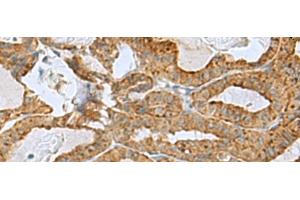 Immunohistochemistry of paraffin-embedded Human thyroid cancer tissue using RPL10A Polyclonal Antibody at dilution of 1:50(x200) (RPL10A antibody)