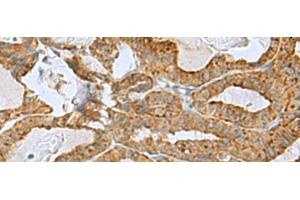 Immunohistochemistry of paraffin-embedded Human thyroid cancer tissue using RPL10A Polyclonal Antibody at dilution of 1:50(x200)