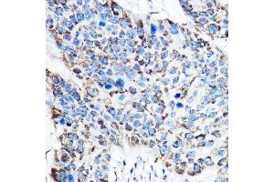 Immunohistochemistry of paraffin-embedded human esophageal cancer using OAT Rabbit pAb (ABIN6127442, ABIN6144985, ABIN6144986 and ABIN6221831) at dilution of 1:150 (40x lens). (OAT antibody  (AA 160-439))
