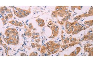 Immunohistochemistry of paraffin-embedded Human breast cancer using AGT Polyclonal Antibody at dilution of 1:30 (AGT antibody)