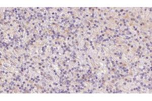 ABIN6273084 at 1/100 staining Human lymph cancer tissue by IHC-P. (UQCRFS1 antibody  (C-Term))