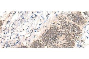 Immunohistochemistry of paraffin-embedded Human colorectal cancer tissue using AURKA Polyclonal Antibody at dilution of 1:40(x200) (Aurora A antibody)