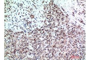 Immunohistochemistry (IHC) analysis of paraffin-embedded Human Breast Cancer, antibody was diluted at 1:200. (TP53INP2 antibody)