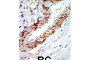 Formalin-fixed and paraffin-embedded human cancer tissue reacted with the primary antibody, which was peroxidase-conjugated to the secondary antibody, followed by DAB staining. (CROT antibody  (C-Term))