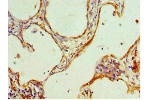 Immunohistochemistry of paraffin-embedded human cervical cancer using ABIN7155200 at dilution of 1:100 (HMGN4 antibody  (AA 1-90))