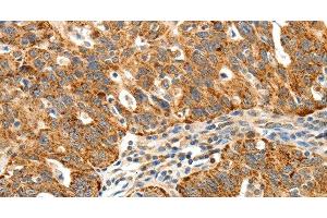 Immunohistochemistry of paraffin-embedded Human ovarian cancer using SSTR1 Polyclonal Antibody at dilution of 1:40 (SSTR1 antibody)