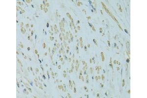Immunohistochemistry of paraffin-embedded Human uterine cancer using UGT1A6 Polyclonal Antibody at dilution of 1:100 (40x lens). (UGT1A6 antibody)