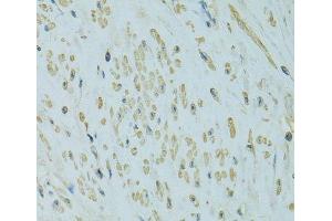 Immunohistochemistry of paraffin-embedded Human uterine cancer using UGT1A6 Polyclonal Antibody at dilution of 1:100 (40x lens). (UGT1A6 antibody)