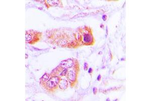 Immunohistochemical analysis of BAIAP2L2 staining in human lung cancer formalin fixed paraffin embedded tissue section. (BAIAP2L2 antibody  (Center))