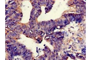Immunohistochemistry of paraffin-embedded human colon cancer using ABIN7172340 at dilution of 1:100 (TNIK antibody  (AA 523-714))