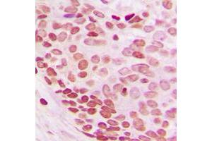 Immunohistochemical analysis of NEDD8 staining in human breast cancer formalin fixed paraffin embedded tissue section. (NEDD8 antibody  (N-Term))