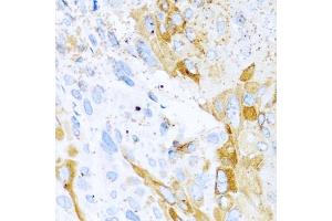 Immunohistochemistry of paraffin-embedded mouse esophageal cancer using SPINT1 antibody (ABIN5973812) at dilution of 1/100 (40x lens). (SPINT1 antibody)