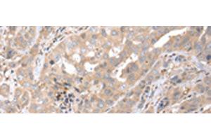 Immunohistochemistry of paraffin-embedded Human breast cancer tissue using PPBP Polyclonal Antibody at dilution of 1:35(x200) (CXCL7 antibody)