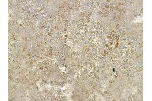 ABIN6260261 and ABIN6269348 at 1/100 staining human melanoma by IHC-P. (BIK antibody  (N-Term))