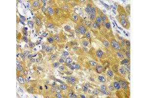 Immunohistochemistry of paraffin-embedded Human esophageal cancer using AK1 Polyclonal Antibody at dilution of 1:100 (40x lens). (Adenylate Kinase 1 antibody)