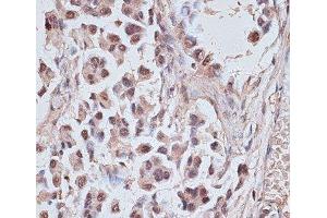 Immunohistochemistry of paraffin-embedded Human lung cancer using NR5A2 Polyclonal Antibody at dilution of 1:100 (40x lens).