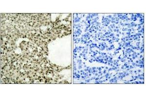 Immunohistochemical analysis of paraffin-embedded human breast carcinoma tissue using STAT1(Phospho-Ser727) Antibody(left) or the same antibody preincubated with blocking peptide(right). (STAT1 antibody  (pSer727))