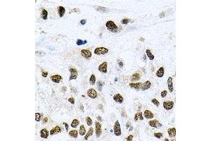 Immunohistochemical analysis of NELF-E staining in human lung cancer formalin fixed paraffin embedded tissue section. (RDBP antibody)