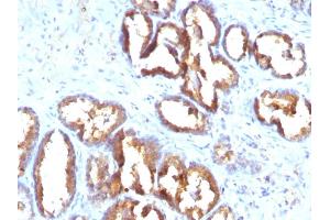 Formalin-fixed, paraffin-embedded human Prostate Carcinoma stained with PSAP Monoclonal Antibody (PASE/4LJ). (ACPP antibody)