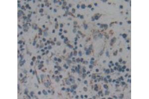 IHC-P analysis of liver cancer tissue, with DAB staining. (ARPC2 antibody  (AA 1-300))