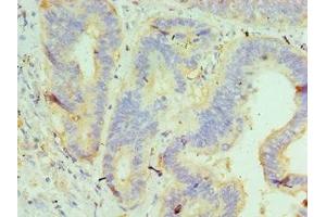Immunohistochemistry of paraffin-embedded human colon cancer using ABIN7145505 at dilution of 1:100 (Glucuronidase beta antibody  (AA 382-651))