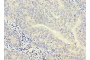 Immunohistochemistry of paraffin-embedded human endometrial cancer using ABIN7147920 at dilution of 1:100 (CPSF4 antibody  (AA 1-244))