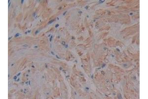DAB staining on IHC-P; Samples: Human Prostate Tissue (MMP2 antibody  (AA 110-660))