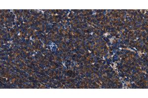 Immunohistochemistry of paraffin-embedded Human Lymphoma tissue using CD45 Polyclonal Antibody at dilution 1:40 (CD45 antibody)
