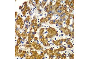 Immunohistochemistry of paraffin-embedded human liver injury using SMAD9 antibody (ABIN5975592) at dilution of 1/100 (40x lens). (SMAD9 antibody)