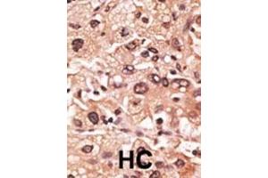 Formalin-fixed and paraffin-embedded human cancer tissue reacted with the primary antibody, which was peroxidase-conjugated to the secondary antibody, followed by AEC staining. (MAGEF1 antibody  (C-Term))