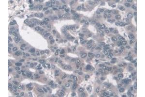 Detection of KLC1 in Human Liver cancer Tissue using Polyclonal Antibody to Kinesin Light Chain 1 (KLC1) (KLC1 antibody  (AA 1-254))