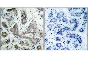 Immunohistochemistry analysis of paraffin-embedded human breast carcinoma tissue, using PDK1 (Ab-241) Antibody. (PDPK1 antibody  (AA 210-259))