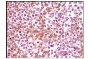 Immunohistochemical analysis of paraffin-embedded human glioma tissue, showing membrane localization using SNCA antibody with DAB staining. (SNCA antibody)