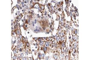ABIN6266641 at 1/100 staining human lung carcinoma tissue sections by IHC-P.