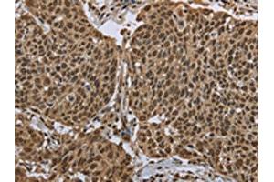 The image on the left is immunohistochemistry of paraffin-embedded Human cervical cancer tissue using ABIN7130674(PPAT Antibody) at dilution 1/50, on the right is treated with fusion protein. (PPAT antibody)
