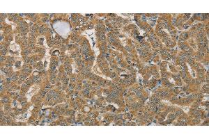 Immunohistochemistry of paraffin-embedded Human thyroid cancer using SDHB Polyclonal Antibody at dilution of 1:30 (SDHB antibody)