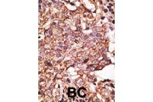 Formalin-fixed and paraffin-embedded human cancer tissue reacted with SIGLEC6 polyclonal antibody  , which was peroxidase-conjugated to the secondary antibody, followed by AEC staining. (SIGLEC6 antibody  (C-Term))