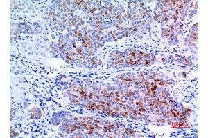 Immunohistochemistry (IHC) analysis of paraffin-embedded Human Mammary Cancer, antibody was diluted at 1:100. (pan Keratin antibody  (pan))