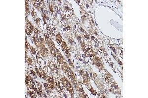 Immunohistochemistry of paraffin-embedded human liver cancer using FBP1 Rabbit mAb (ABIN7267269) at dilution of 1:100 (40x lens). (FBP1 antibody)