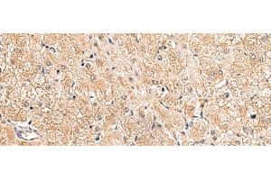 Immunohistochemistry of paraffin-embedded Human liver cancer tissue using LRG1 Polyclonal Antibody at dilution of 1:80(x200) (LRG1 antibody)
